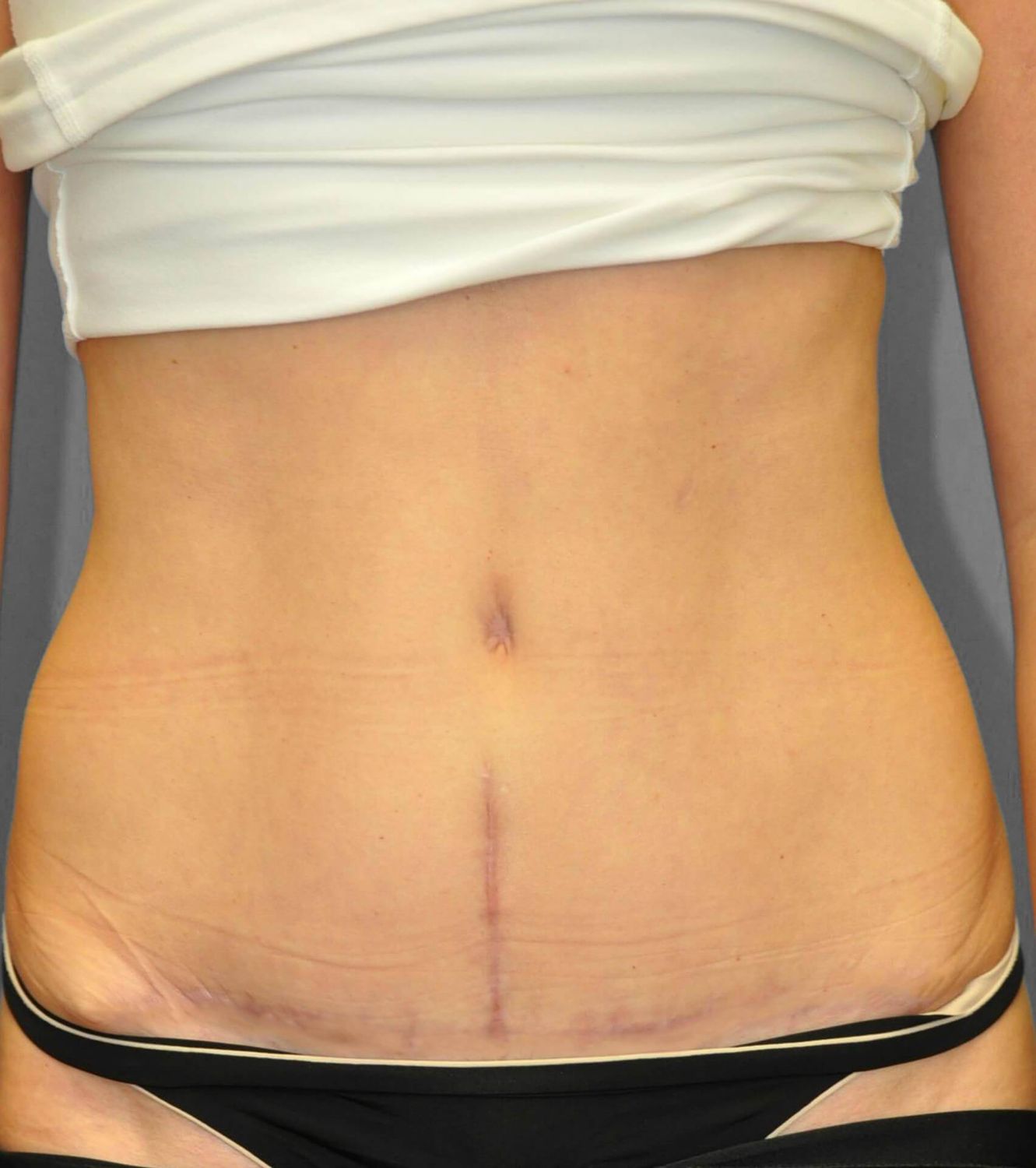 Tummy Tuck Before & After