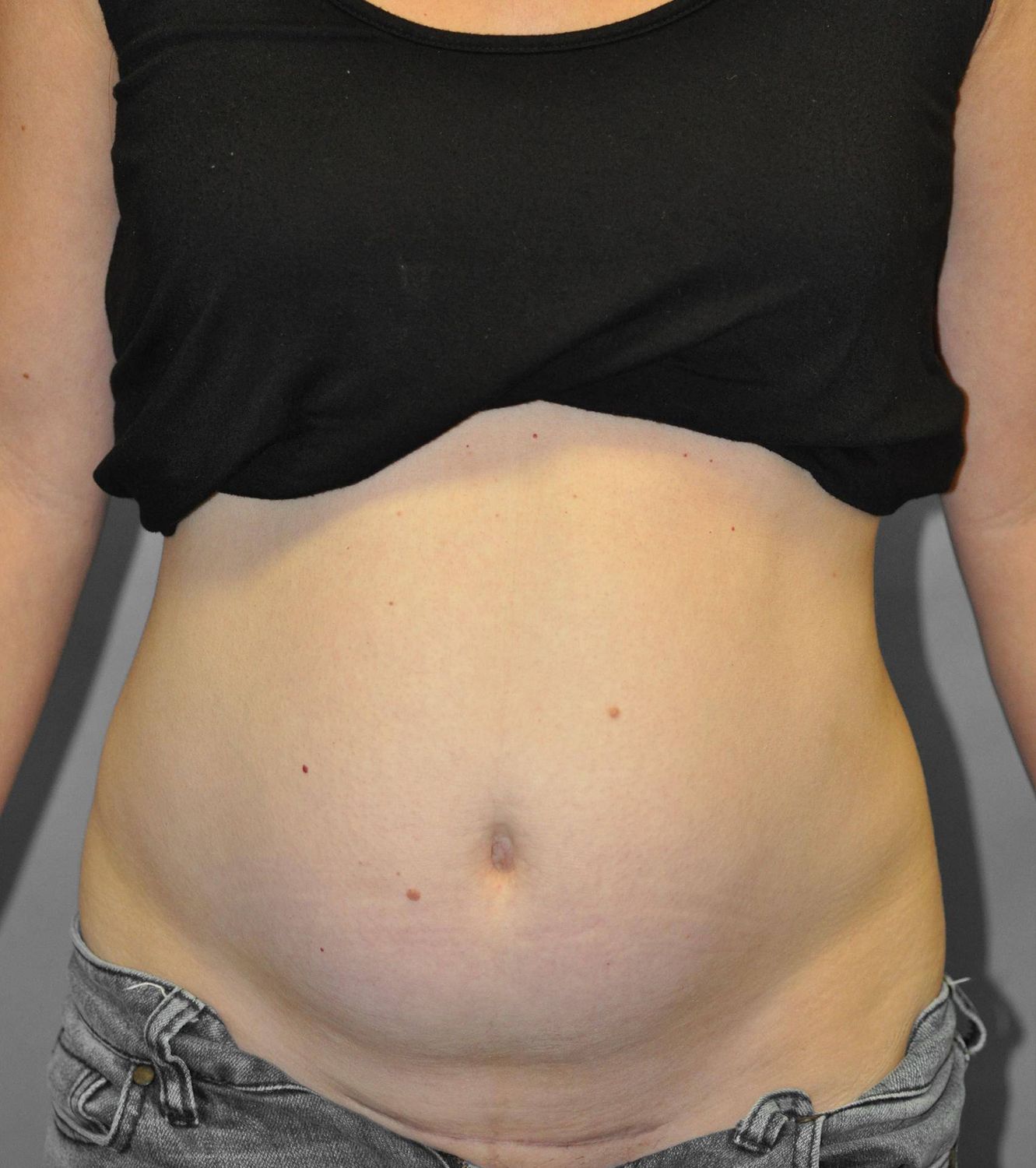 Tummy Tuck Before & After