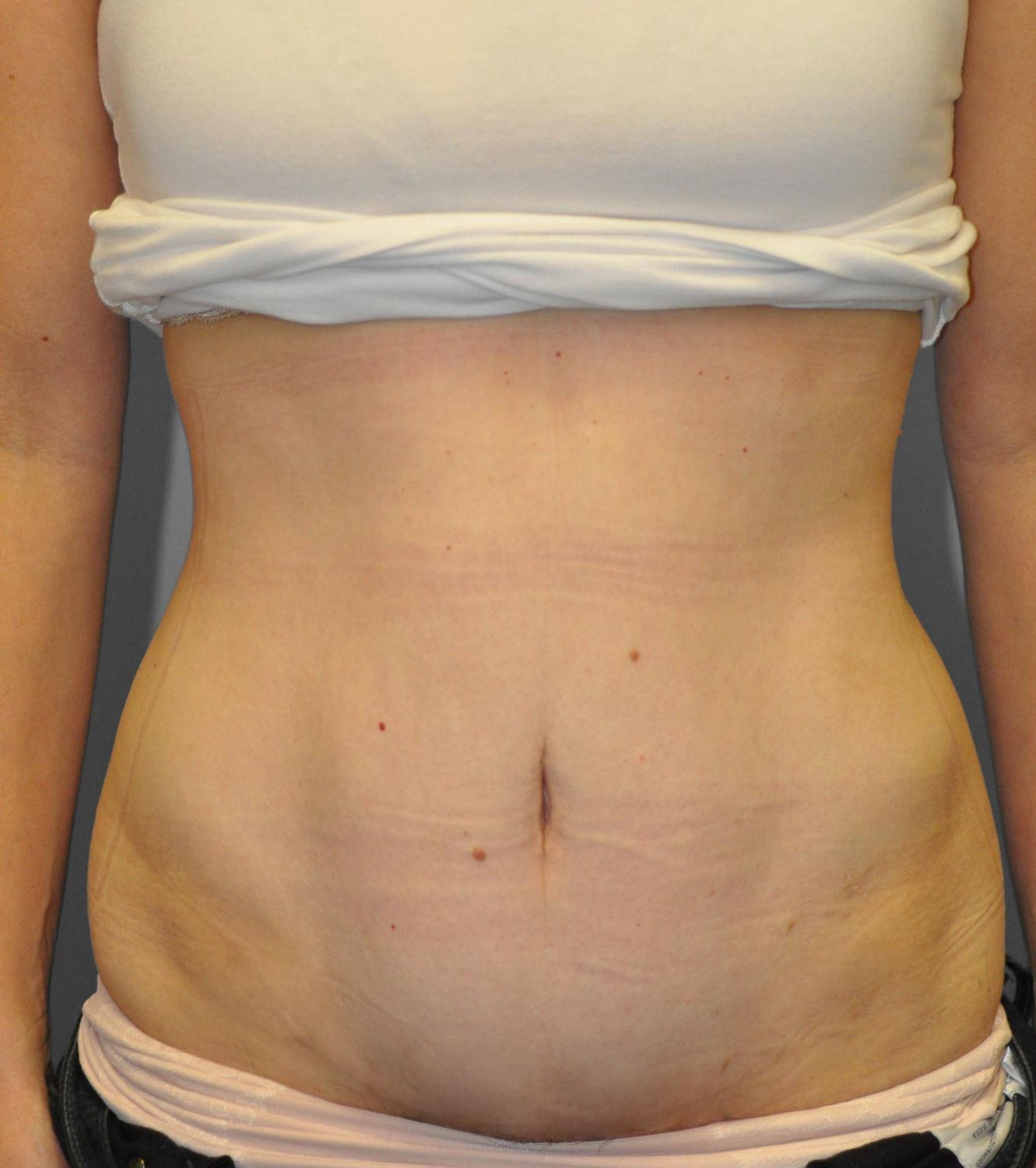 Tummy Tuck Before & After