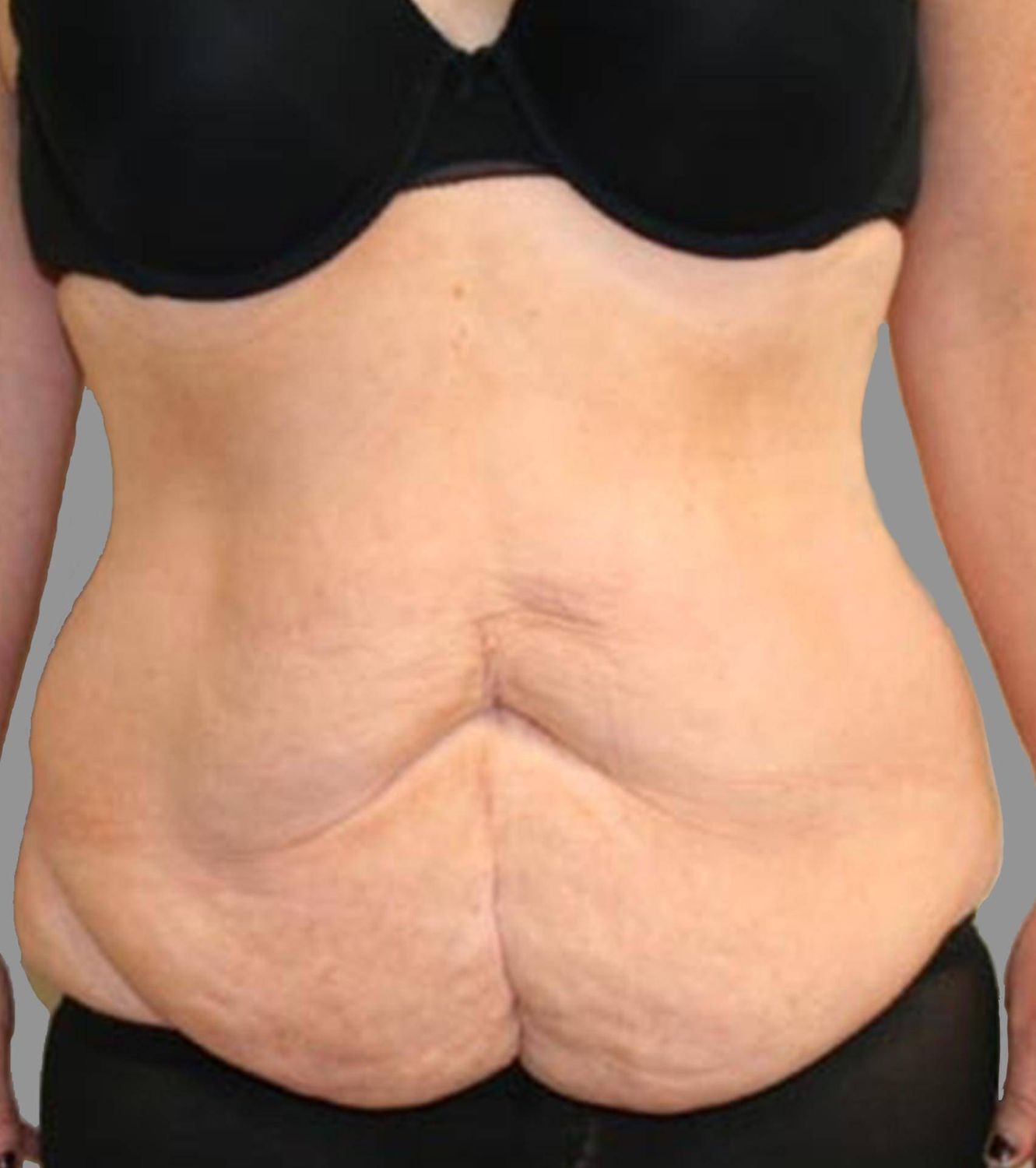 Tummy Tuck Before & After