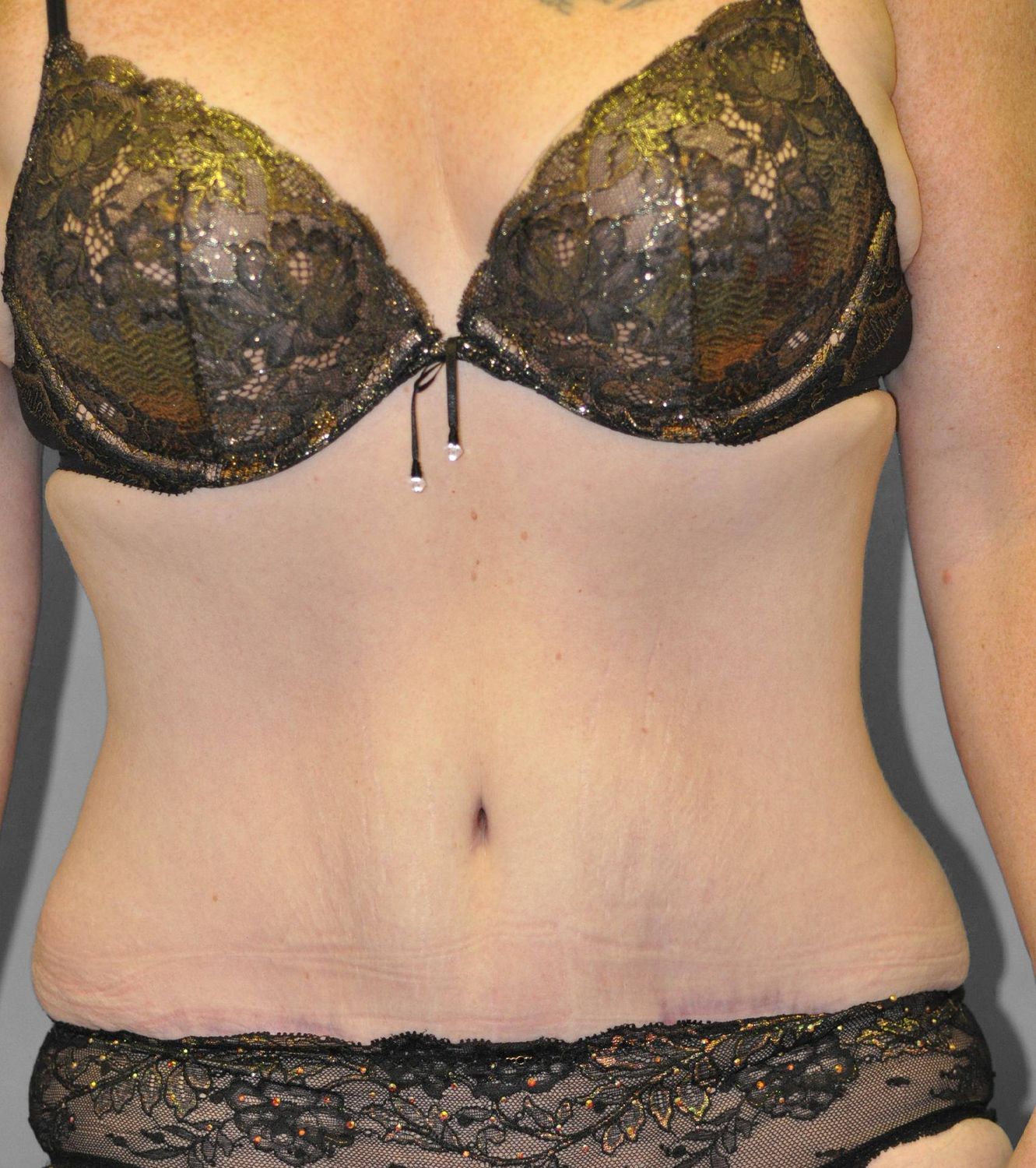Tummy Tuck Before & After