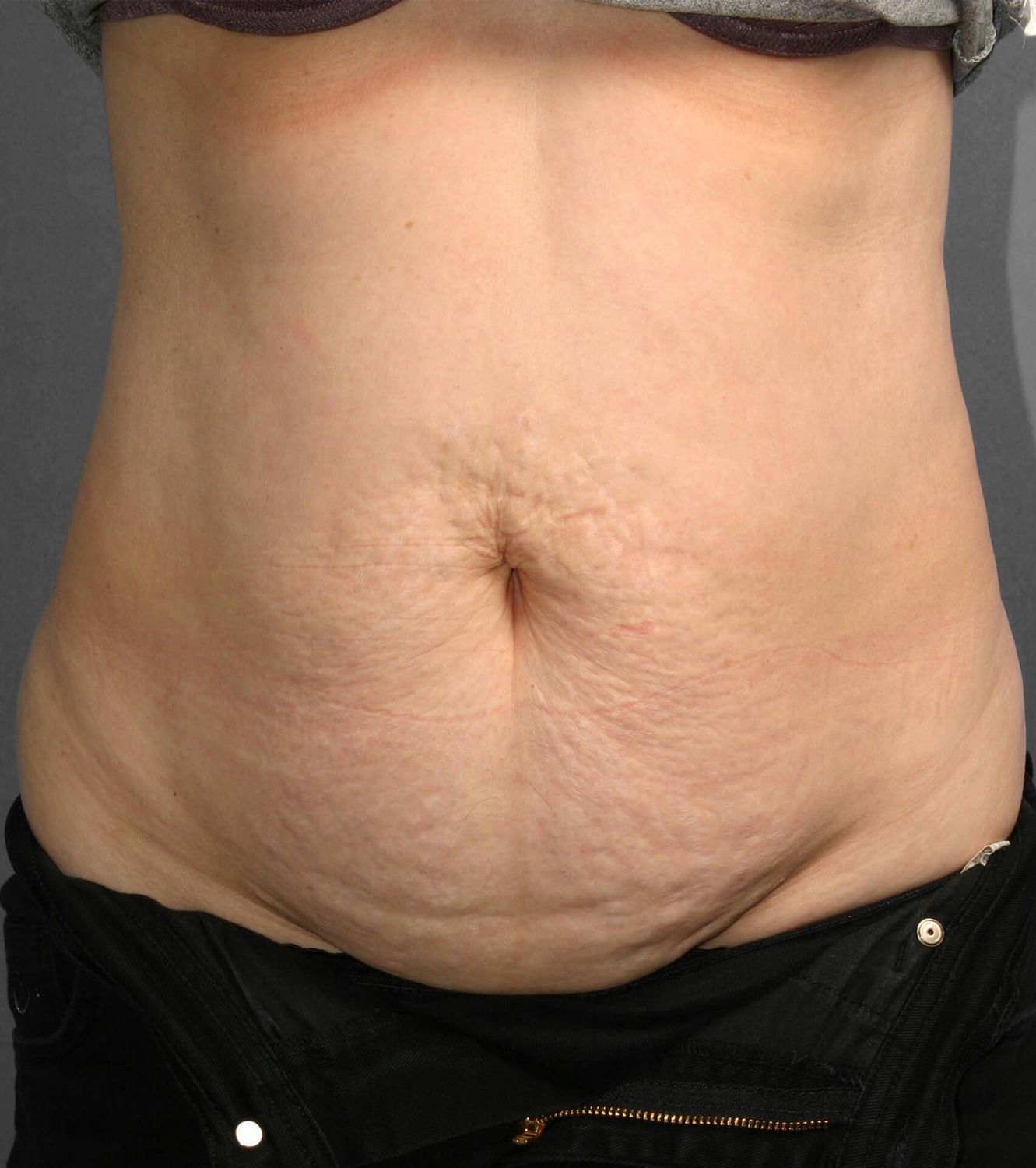 Tummy Tuck Before & After
