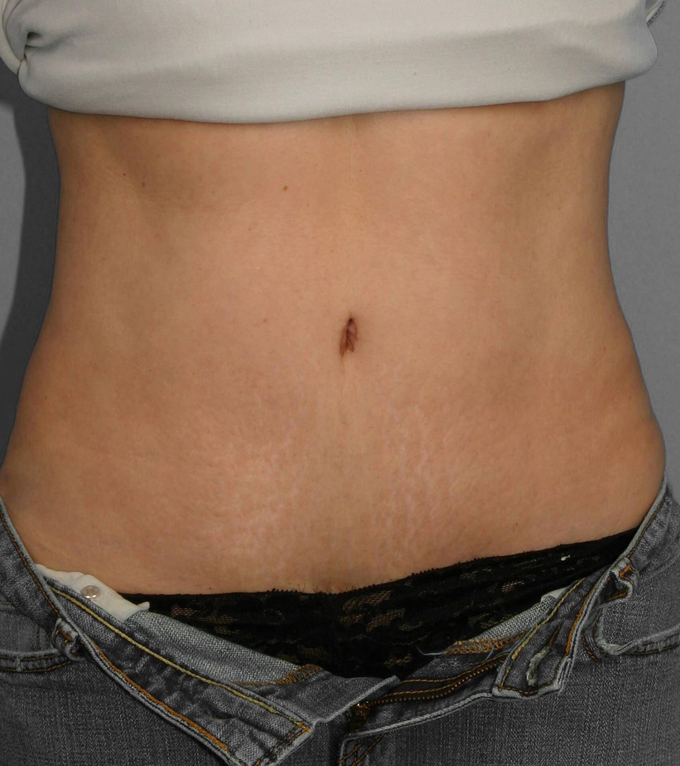 Tummy Tuck Before & After