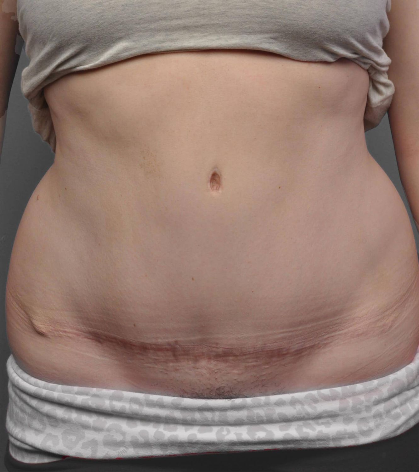 Tummy Tuck Before & After