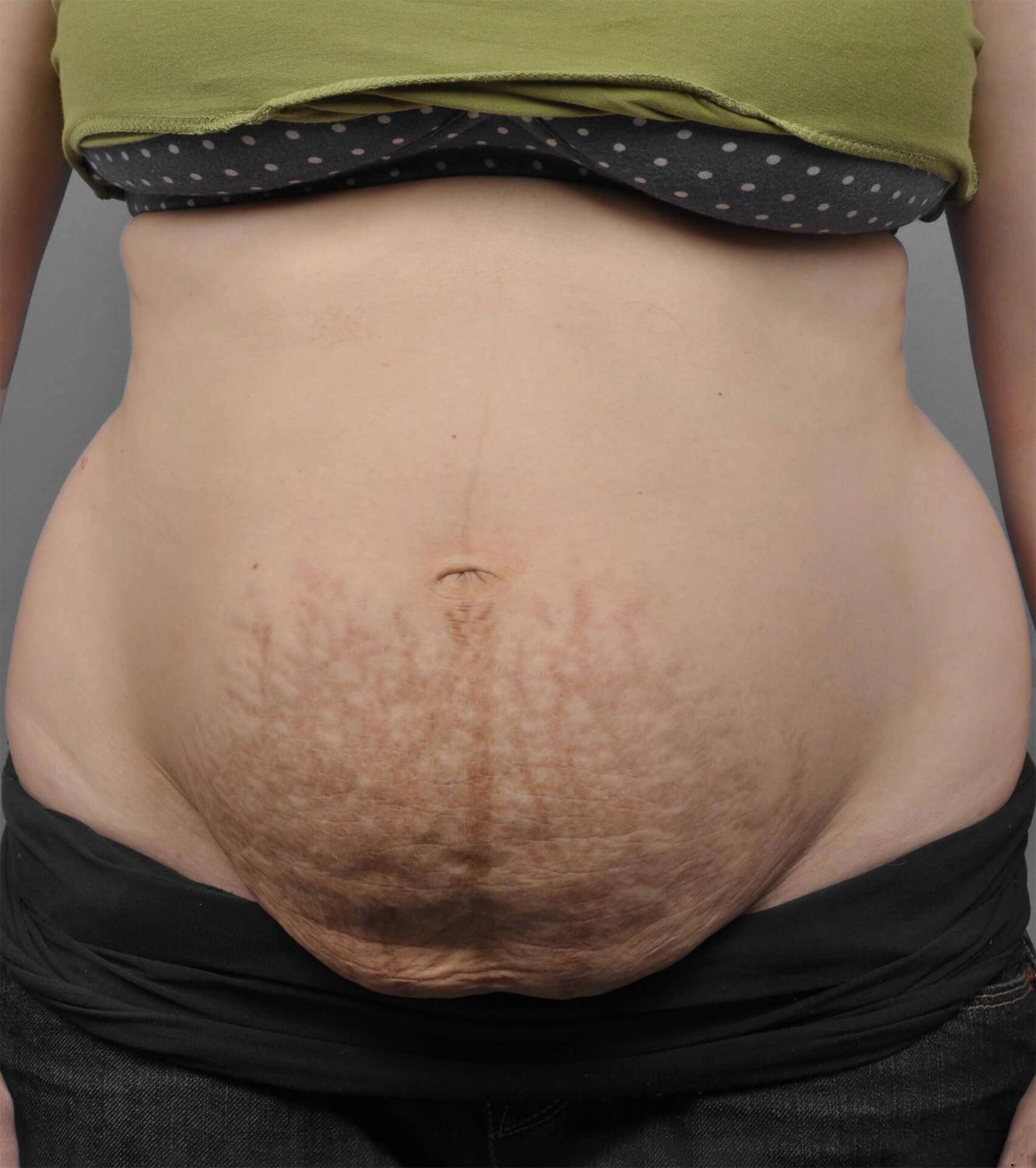 Tummy Tuck Before & After