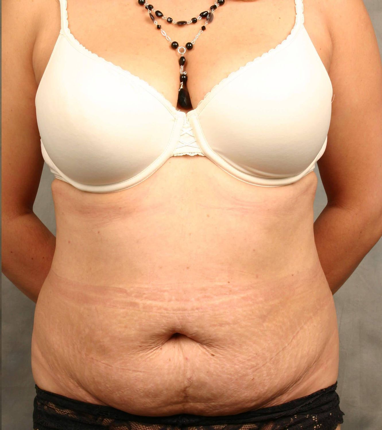 Tummy Tuck Before & After