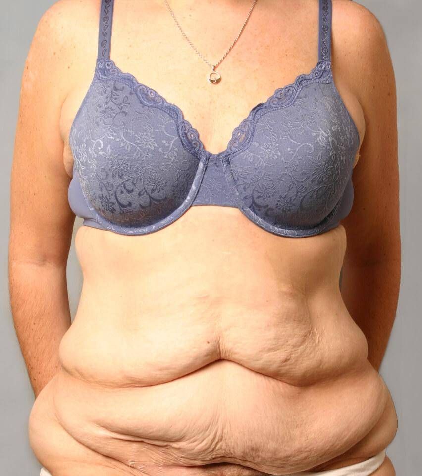 Tummy Tuck Before & After