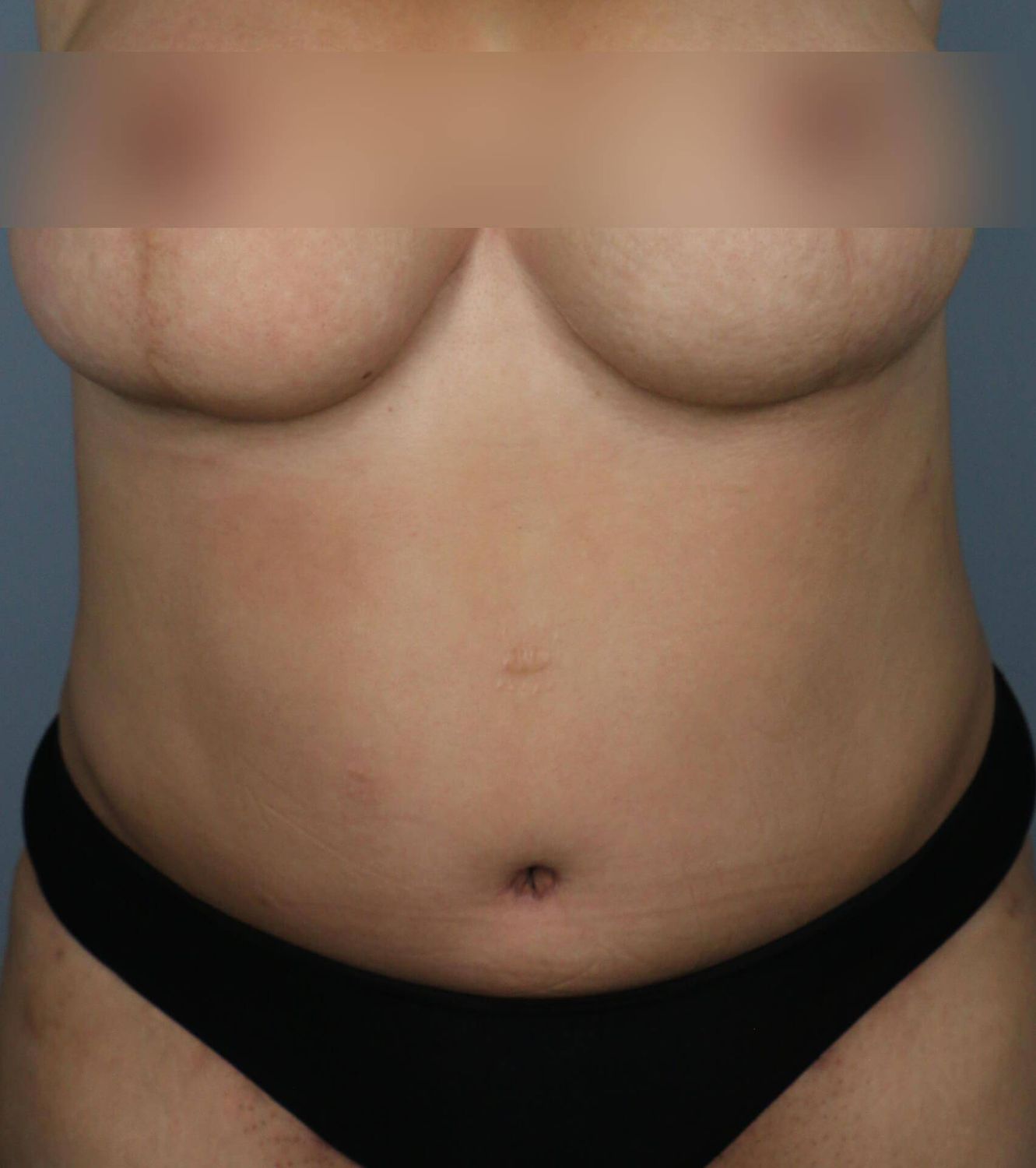 Tummy Tuck Before & After