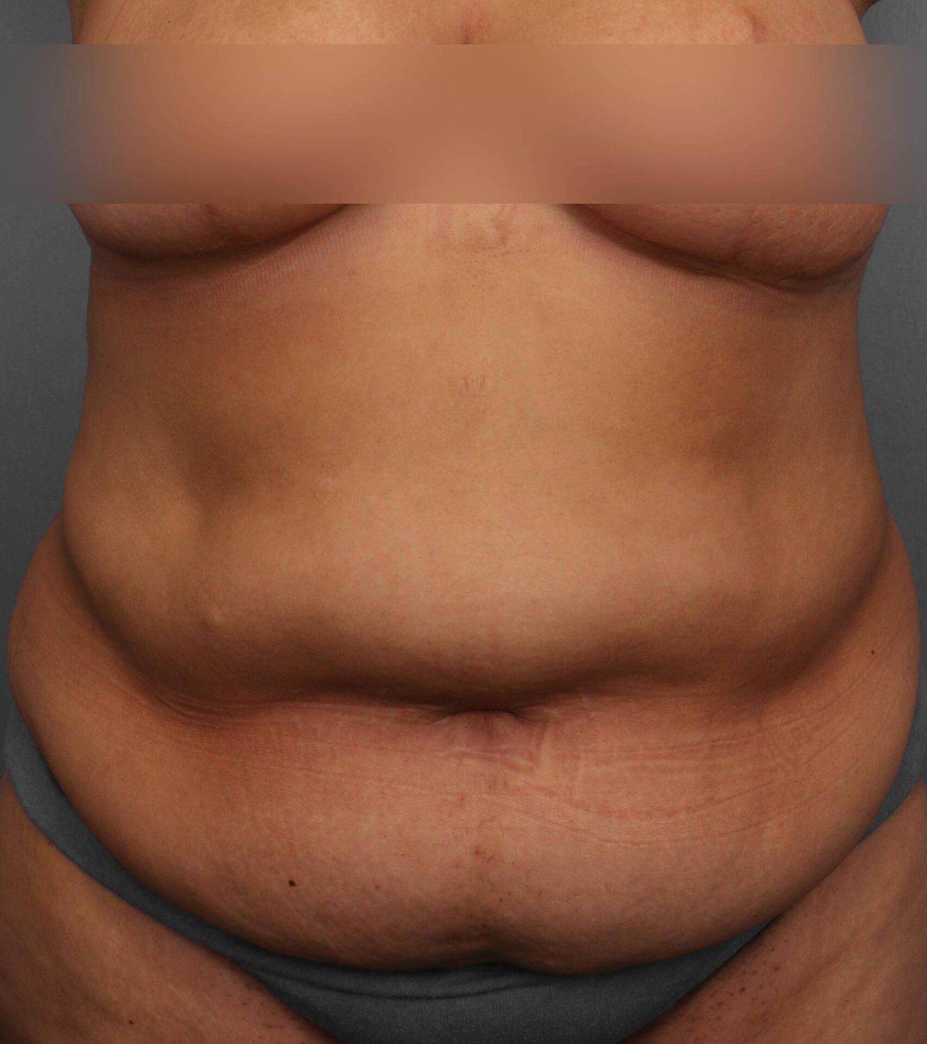 Tummy Tuck Before & After